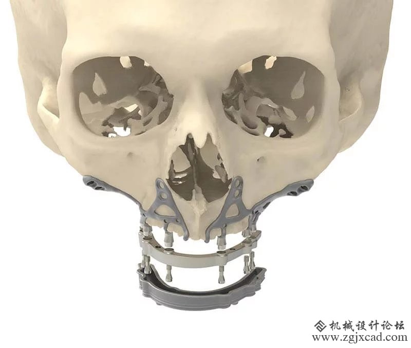 CADSkills开发3D打印钛颌植入物可以减少手术时间