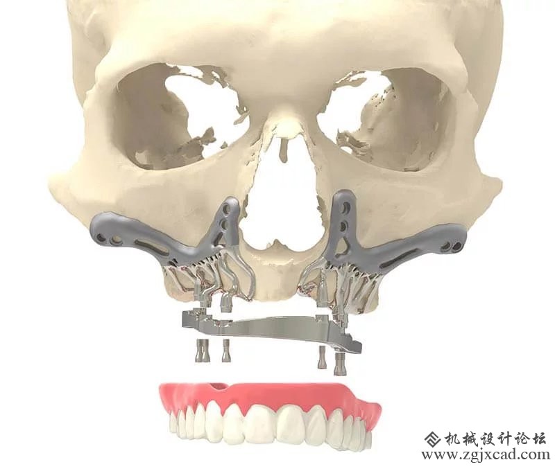 CADSkills开发3D打印钛颌植入物可以减少手术时间
