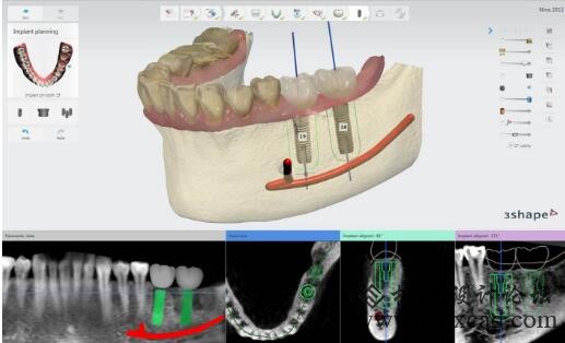 CT影像、三维设计、DLP3D打印推动下的种植牙导板数字化技术
