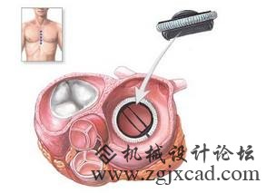 心脏瓣膜