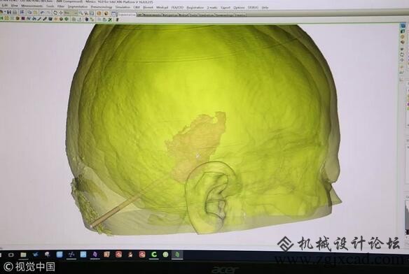 告别反人类的规格化植入体，3D打印关节了解一下