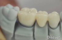 担心3D打印牙齿容易脱落？选对树脂材料才是关键第一步！